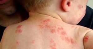 Bệnh chốc mùa hè: Nhận biết sớm để tránh biến chứng