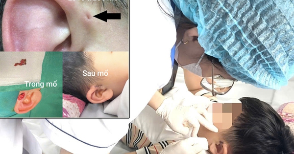 Hi hữu ca rò luân nhĩ di truyền qua 3 thế hệ