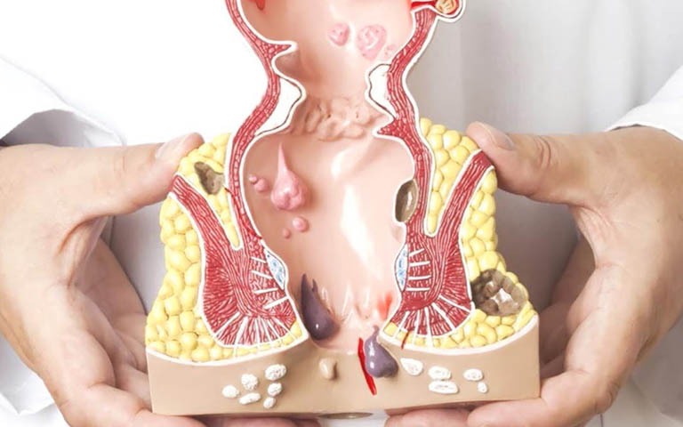 Bệnh trĩ ngoại có gây biến chứng không?