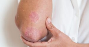 Người mắc bệnh vảy nến đối mặt áp lực tâm lý kéo dài nhiều năm
