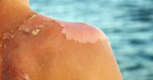 Bỏng nắng phải làm gì để tránh tổn thương da nghiêm trọng?