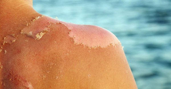 Bỏng nắng phải làm gì để tránh tổn thương da nghiêm trọng?