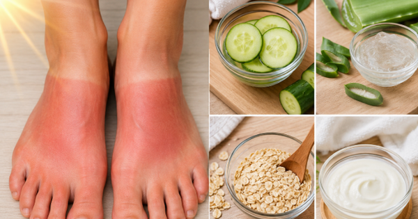 5 cách tự nhiên giúp làm dịu, cải thiện tình trạng cháy nắng ở bàn chân