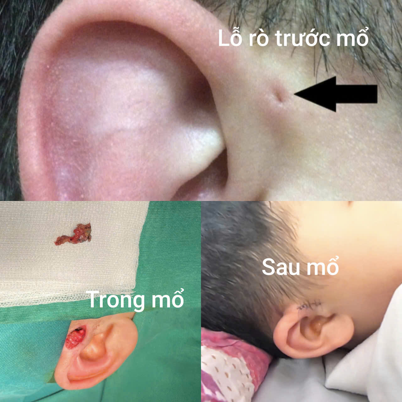 Hi hữu ca rò luân nhĩ di truyền qua 3 thế hệ- Ảnh 2. Hi hữu ca rò luân nhĩ di truyền qua 3 thế hệ- Ảnh 2.