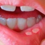 Phân biệt nhiệt miệng và ung thư lưỡi: Cách nhận biết sớm căn bệnh nguy hiểm