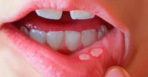 Phân biệt nhiệt miệng và ung thư lưỡi: Cách nhận biết sớm căn bệnh nguy hiểm