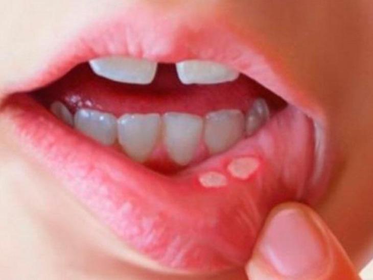 Phân biệt nhiệt miệng và ung thư lưỡi: Cách nhận biết sớm căn bệnh nguy hiểm- Ảnh 1.