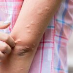 Mề đay dễ bùng phát khi nắng nóng: 3 cách làm giảm ngứa, dịu da