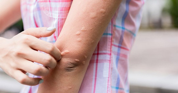Mề đay dễ bùng phát khi nắng nóng: 3 cách làm giảm ngứa, dịu da