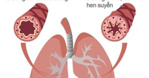 Khi nào người bệnh hen cần đến viện ngay lập tức?