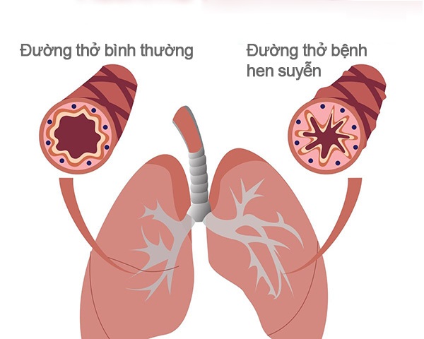 Khi nào người bệnh hen cần đến viện ngay lập tức?- Ảnh 1. Cách phòng ngừa bệnh hen suyễn và bác sĩ chữa hen giỏi Hà Nội