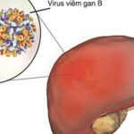 Viêm gan B có lây qua ăn uống, ôm hôn không và cách phòng tránh