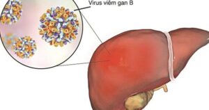 Viêm gan B có lây qua ăn uống, ôm hôn không và cách phòng tránh