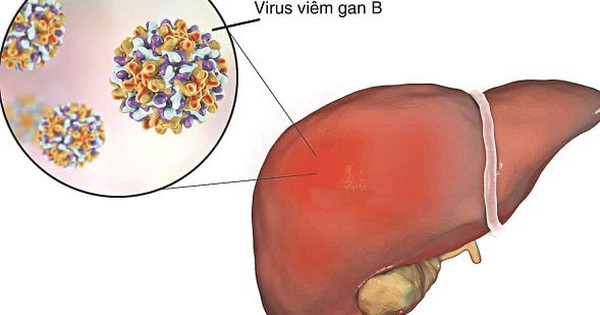 Viêm gan B có lây qua ăn uống, ôm hôn không và cách phòng tránh