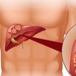 Người mắc viêm gan B sẽ rất nguy hiểm nếu tự ý làm điều này