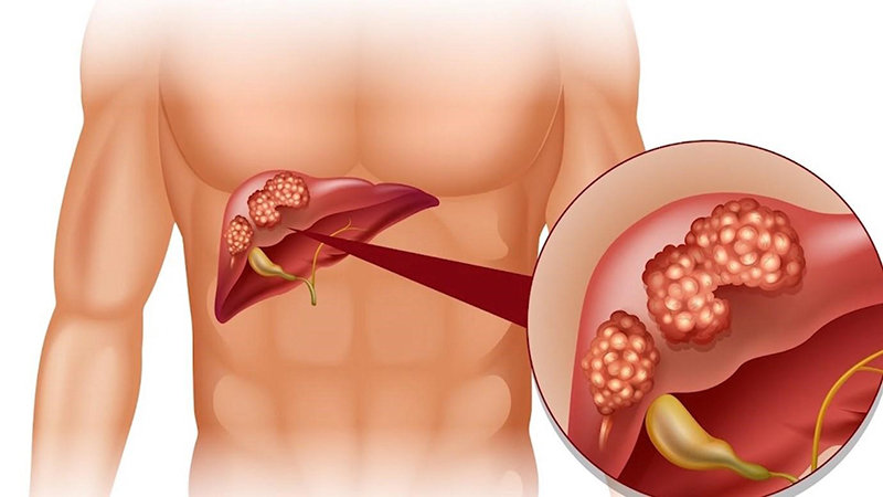 Giải đáp thắc mắc về bệnh Viêm Gan B