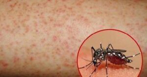 Hơn 1.100 ca mắc sốt xuất huyết, Lâm Đồng kích hoạt các biện pháp phòng, chống dịch