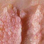 Dấu hiệu nhận biết sớm bệnh sùi mào gà ở phụ nữ