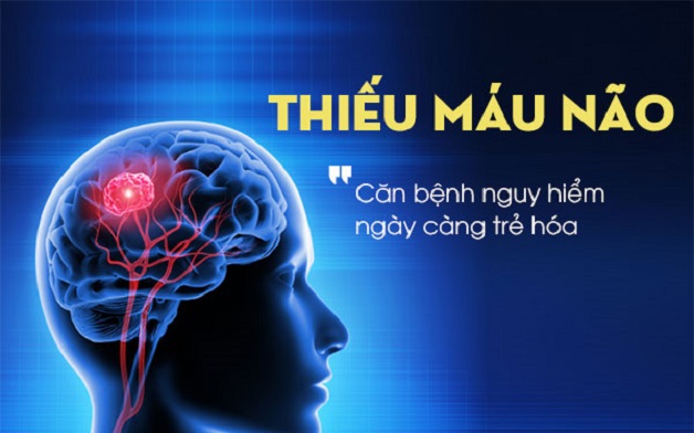 Bí quyết giảm nguy cơ cơn thiếu máu não thoáng qua