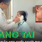 Phẫu thuật u tuyến mang tai chèn ép dây thần kinh, trả lại nụ cười cho người phụ nữ 52 tuổi