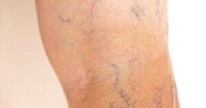 8 cách giúp cải thiện bệnh suy giãn tĩnh mạch tại nhà