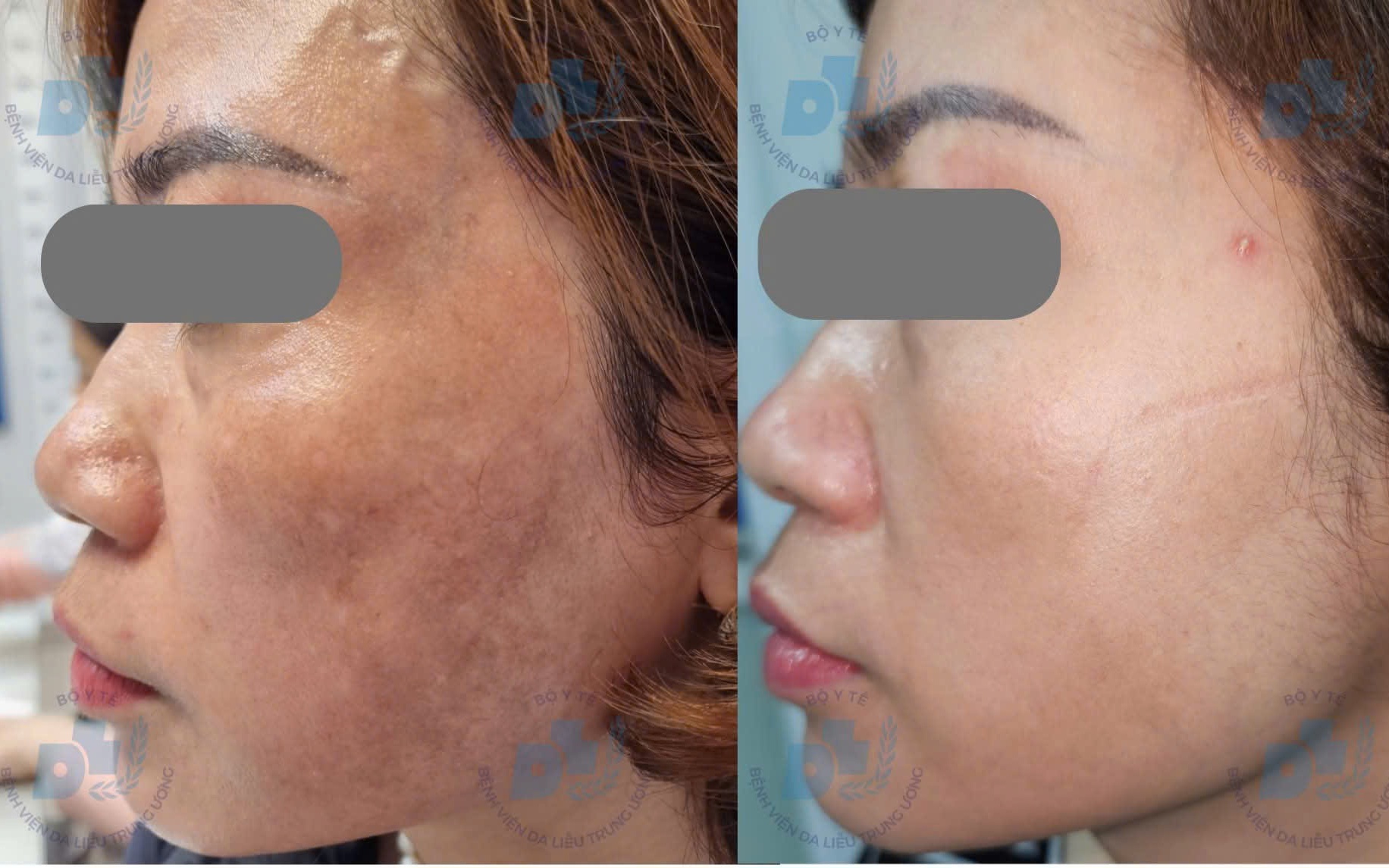 Bác sĩ chỉ rõ lý do nhiều người trị nám tốn kém nhưng vẫn tái phát