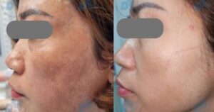 Bác sĩ chỉ rõ lý do nhiều người trị nám tốn kém nhưng vẫn tái phát