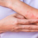 Nắng nóng khiến nguy cơ viêm da gia tăng, phòng ngừa thế nào?