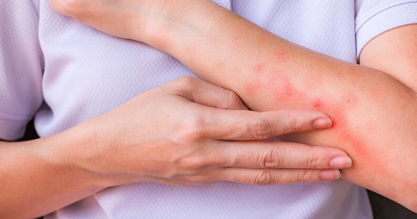 Nắng nóng khiến nguy cơ viêm da gia tăng, phòng ngừa thế nào?
