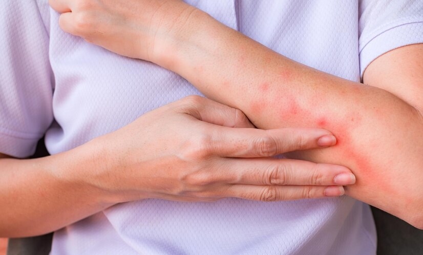 Nắng nóng khiến nguy cơ viêm da gia tăng, phòng ngừa thế nào?- Ảnh 2.